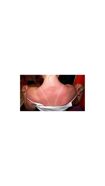 La vérité sur le "bronzage classique"
