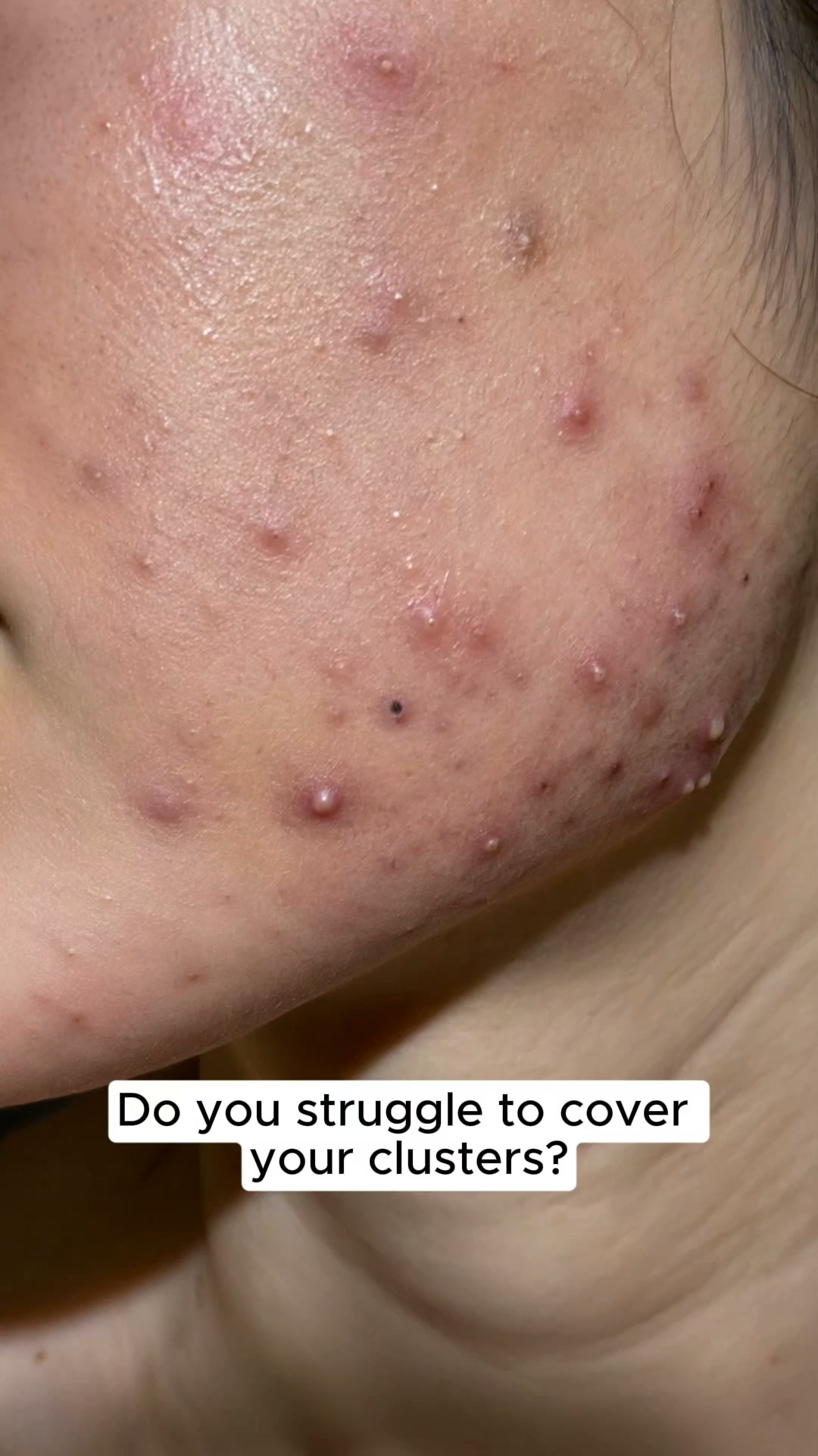 ClearTheory Is Solving Ireland's Biggest Pimple Patch Problem