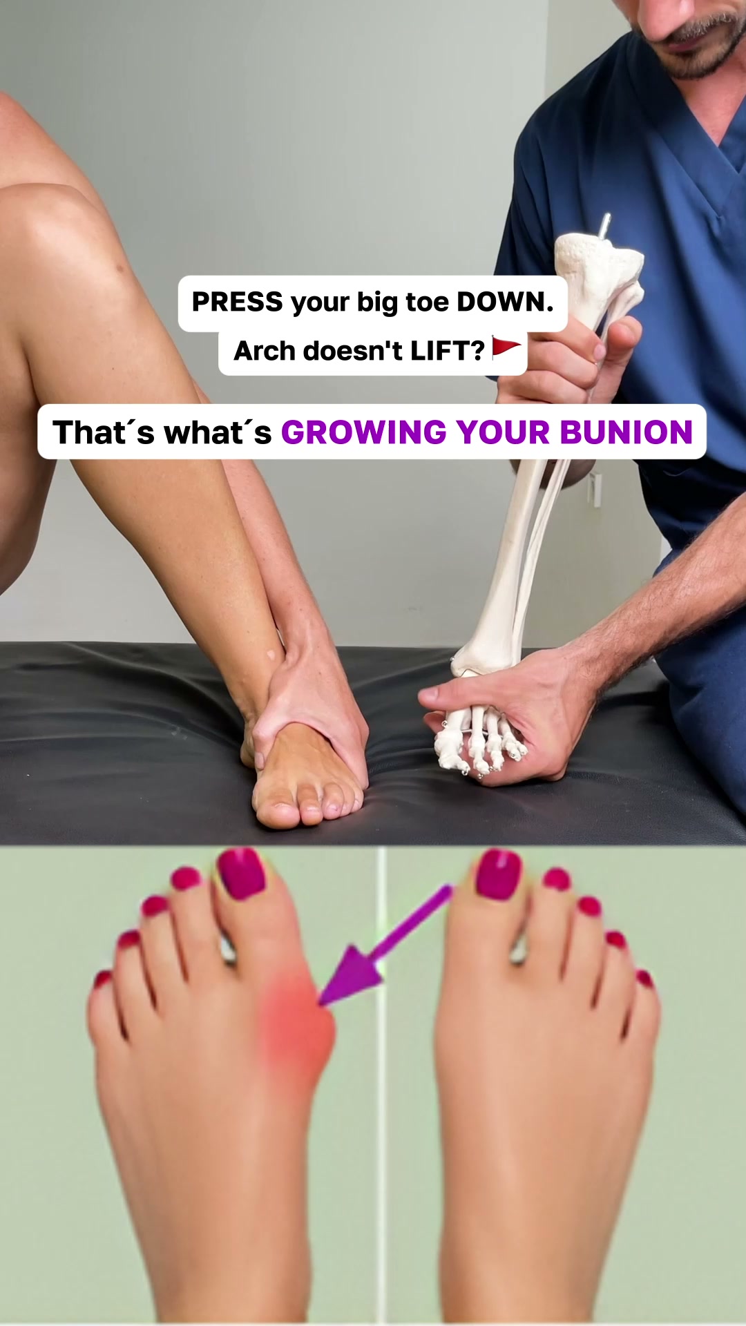 Bunion Reset