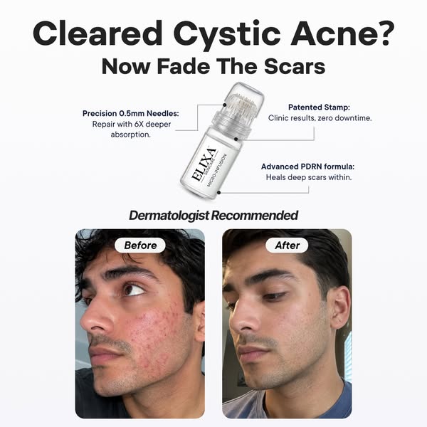 Salmon DNA Heals Acne Scars