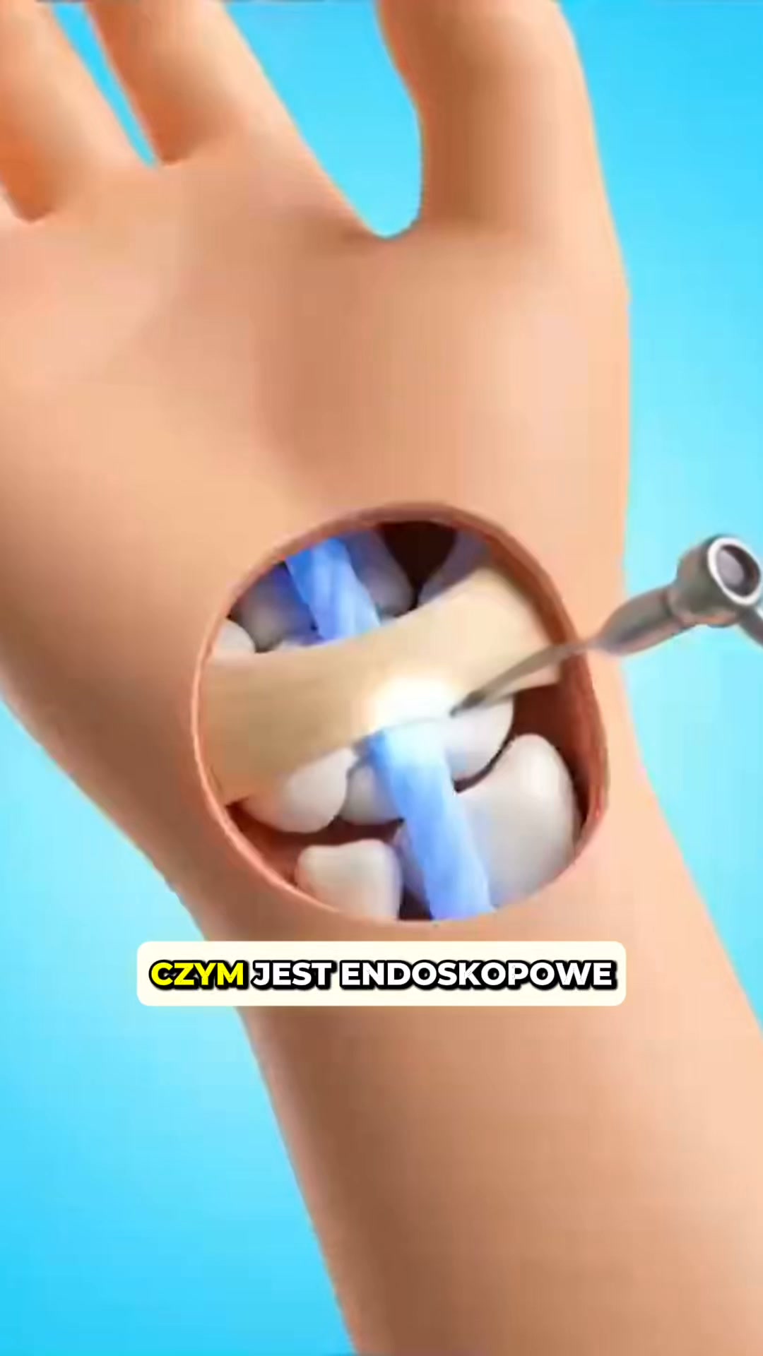 NOWOŚĆ: Koniec z drętwieniem dłoni