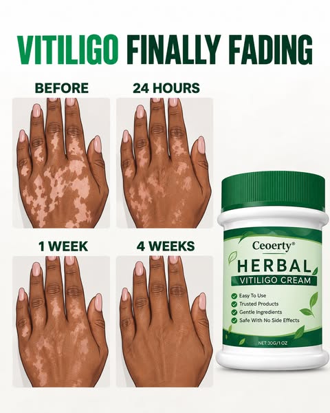 Fast and easy fix for vitiligo.