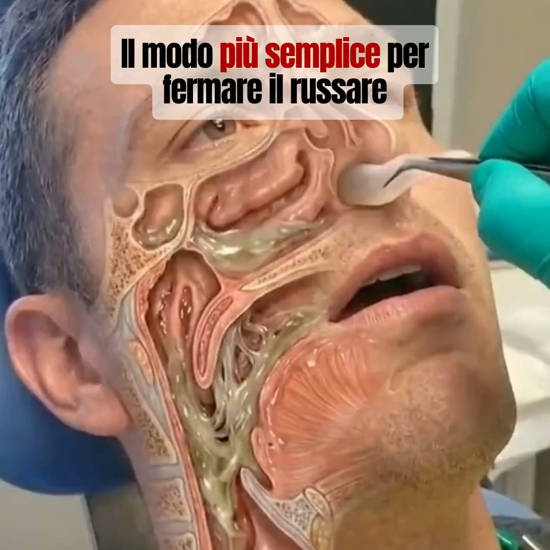 Ferma il russare dalla prima notte