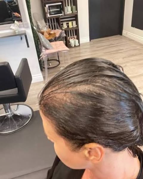 I lost two and a half stone on Mounjaro. Then I lost half my hair.