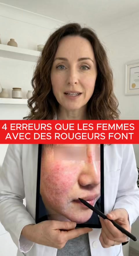 Le mythe de la rosacée : la véritable raison pour laquelle les poussées reviennent toujours en été