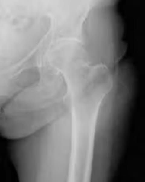 Can Hip Pain Be Treated That Fast?