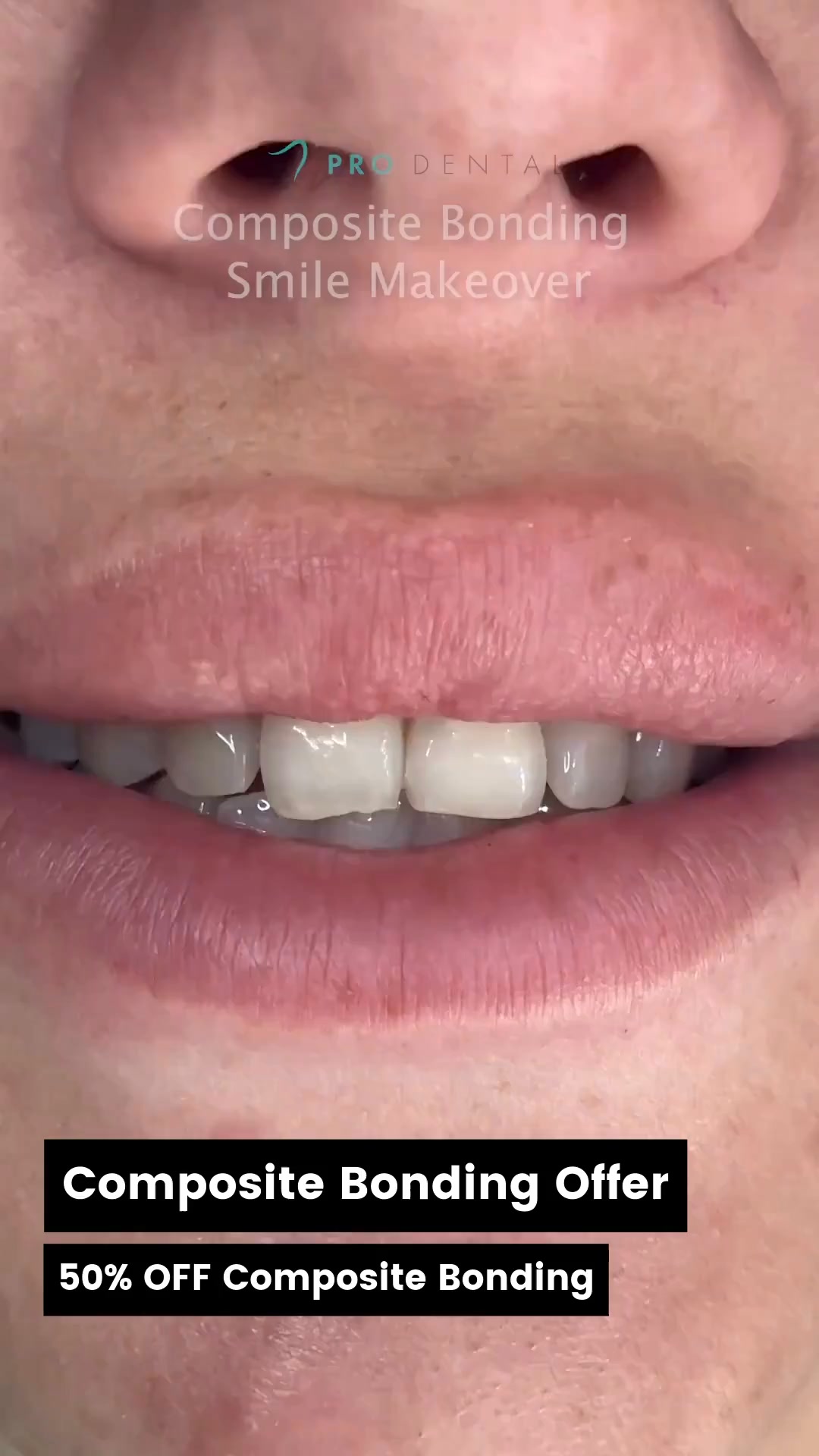 Up to 50% Composite Bonding and Veneers