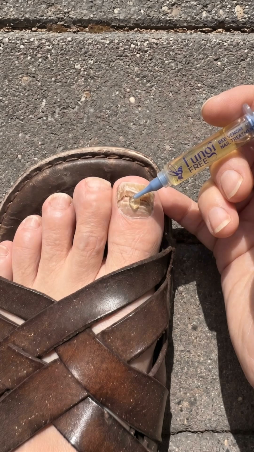 Stop Waiting for a GP | Clear Fungal Nails at Home