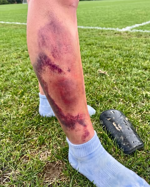 3 MONTHS OUT BECAUSE OF SHIN PADS