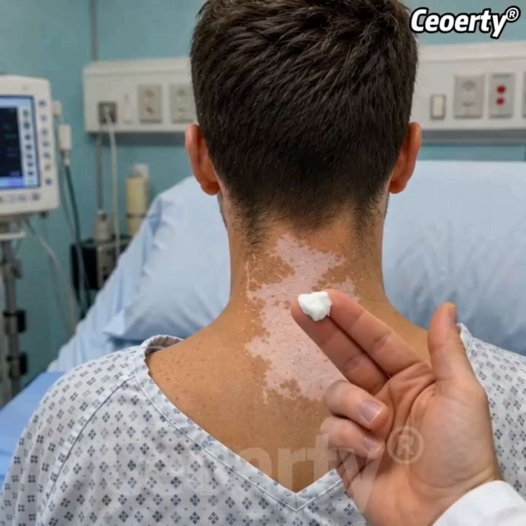 Fast and easy fix for vitiligo.