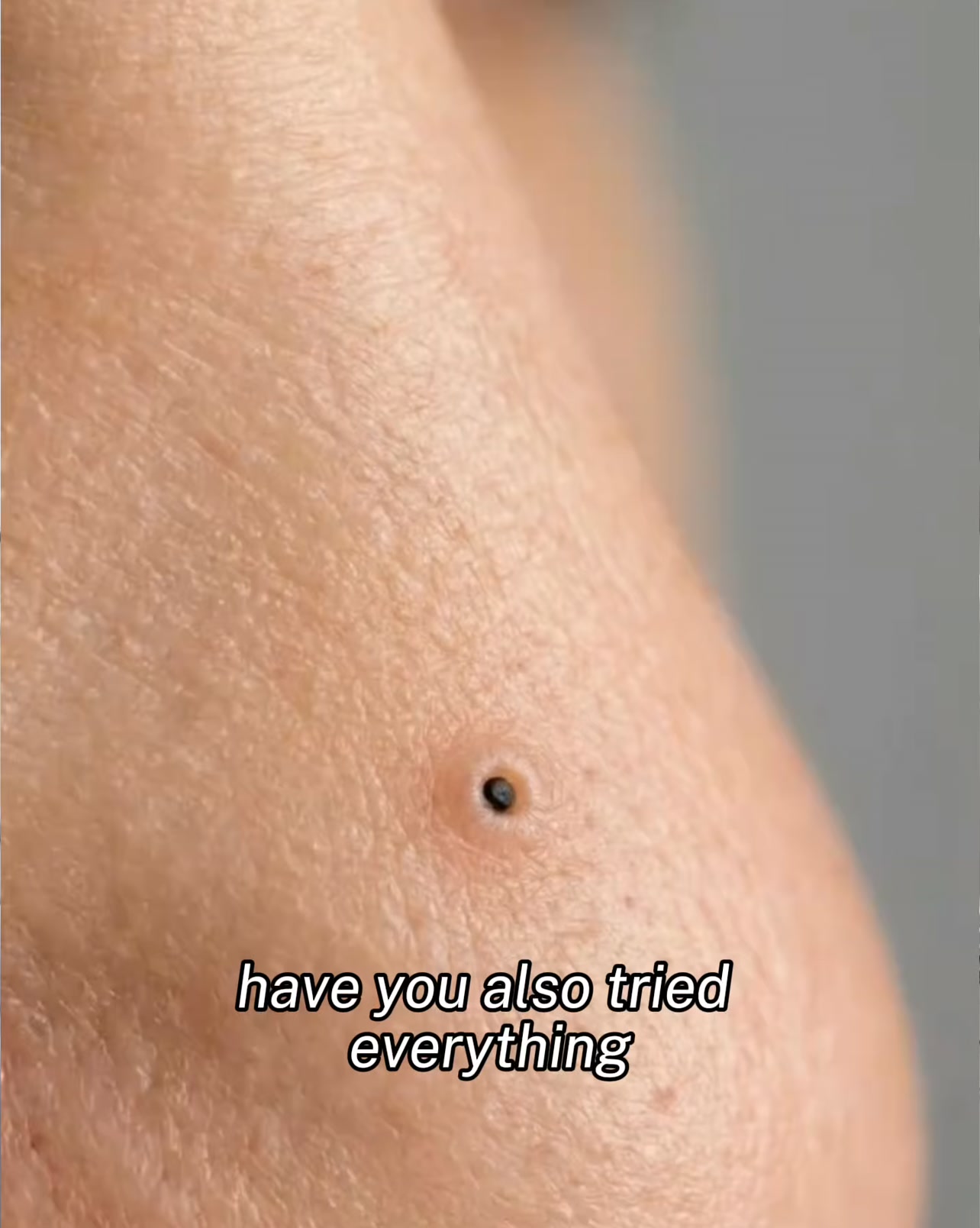 Stop acne now!