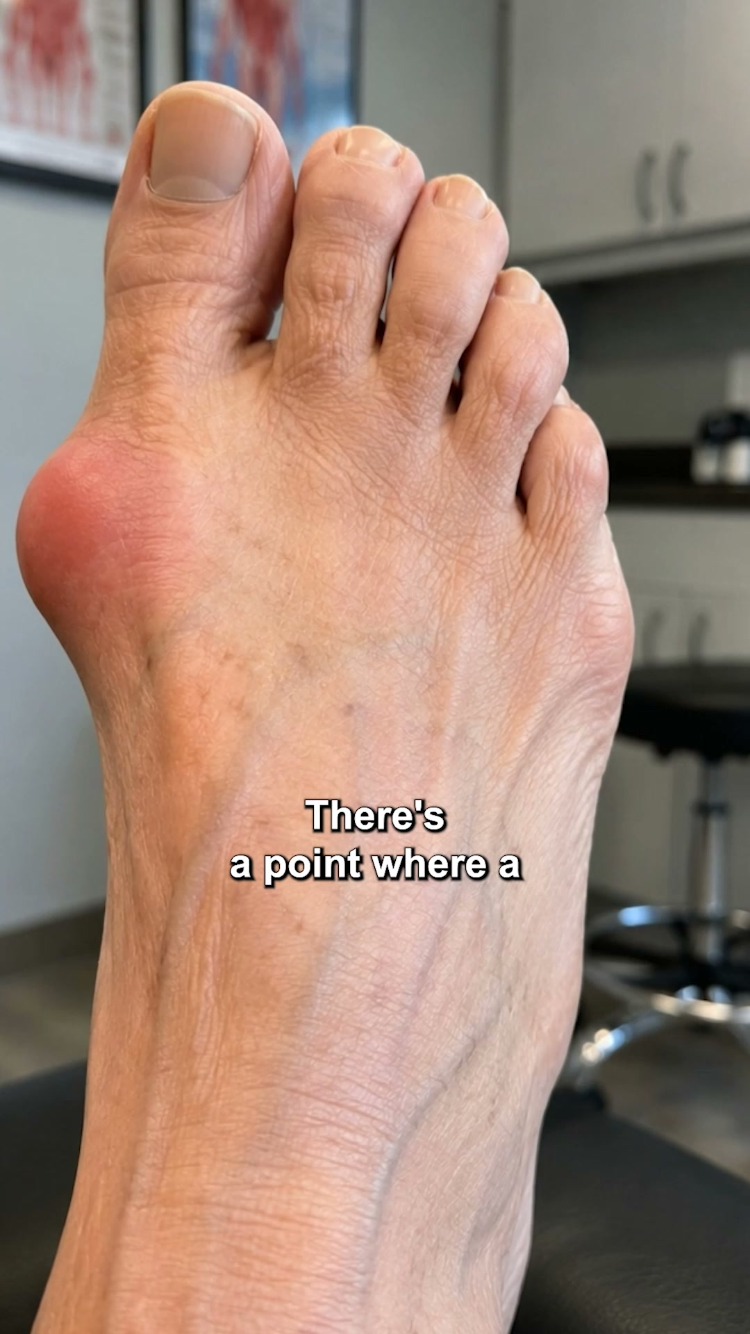 If you cut a bunion off, it grows back