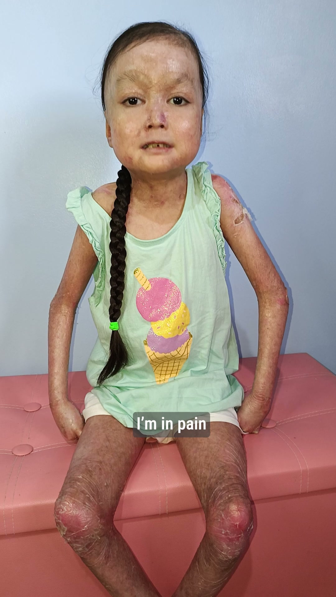 Shamila’s Skin Is Falling Off. Help Her.