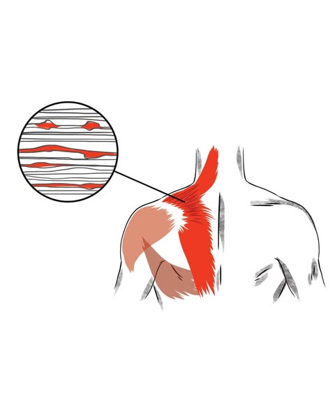 I Had A Knot Behind My Right Shoulder Blade For 22 Years. Rib Removal Surgery Was Next. Then Allison Asked One Question.