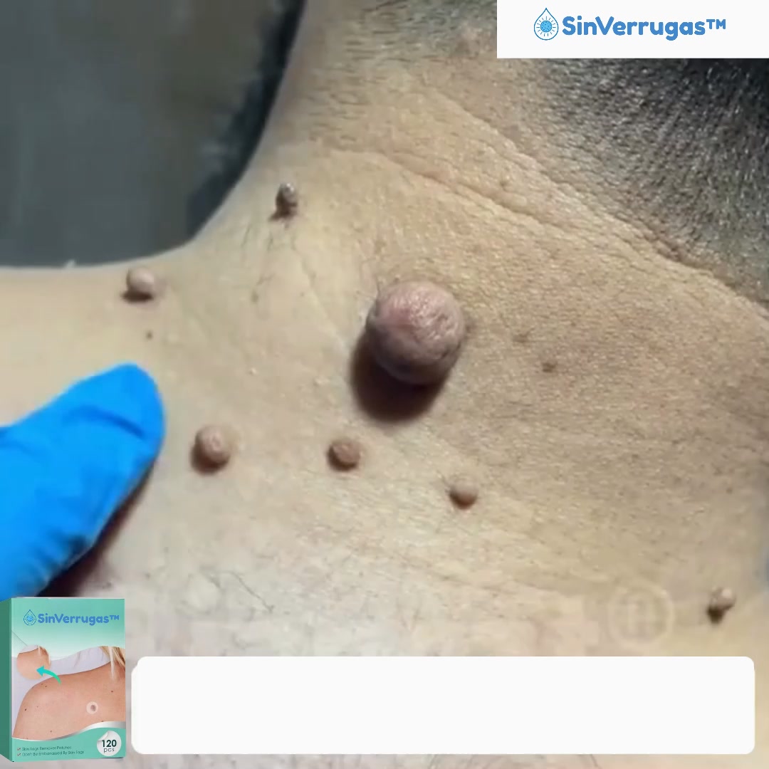 Elimina suavemente as verrugas e os sinais!