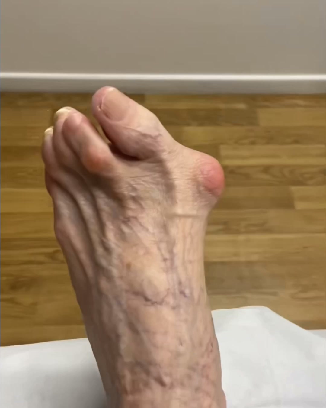 15-Min Bunion Relief With EMS | 50% OFF