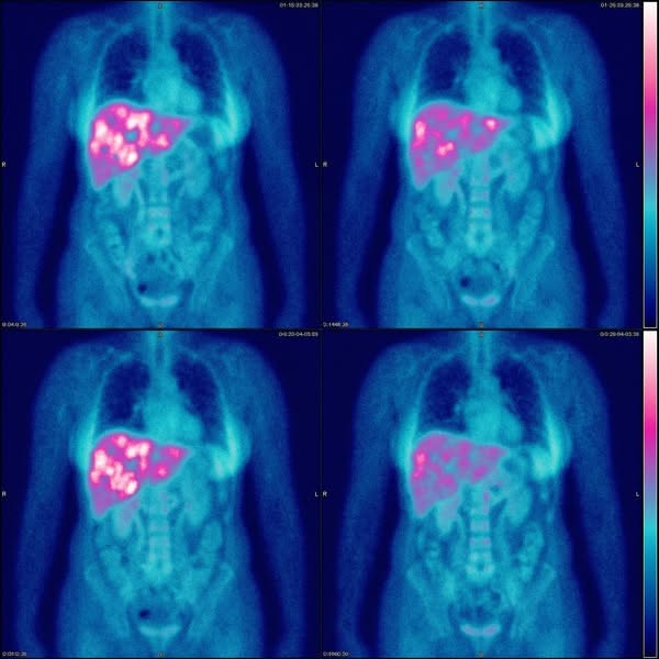 Fatty Liver? It's Not About Your Weight...