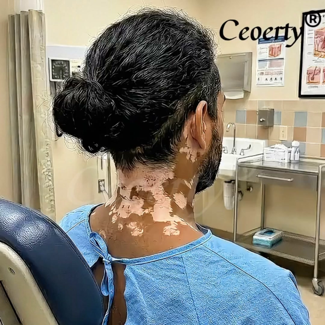 Fast and easy fix for vitiligo.