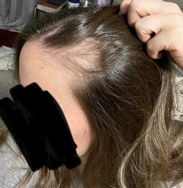 My answer for losing my hair + energy