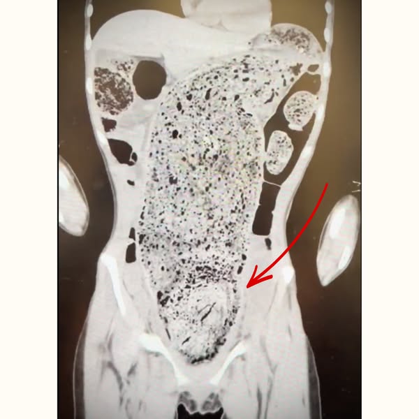 The One Part of Digestion Nobody Checks After 45