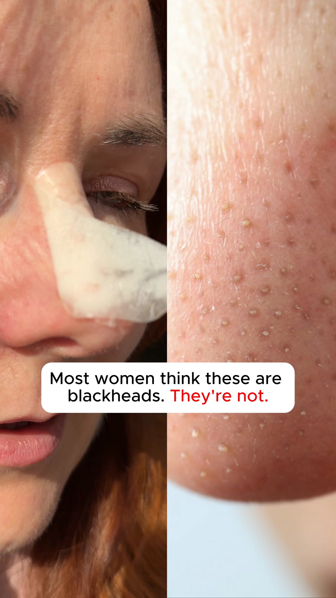 Stop Treating Blackheads Wrong