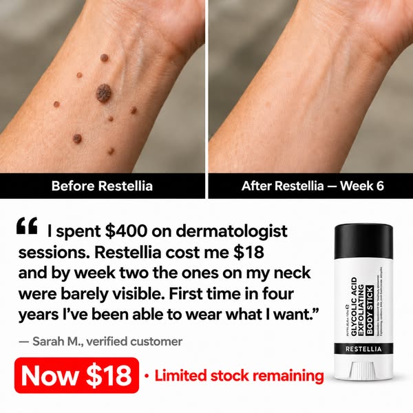 Finally Get Ahead Of Your Seborrheic Keratoses