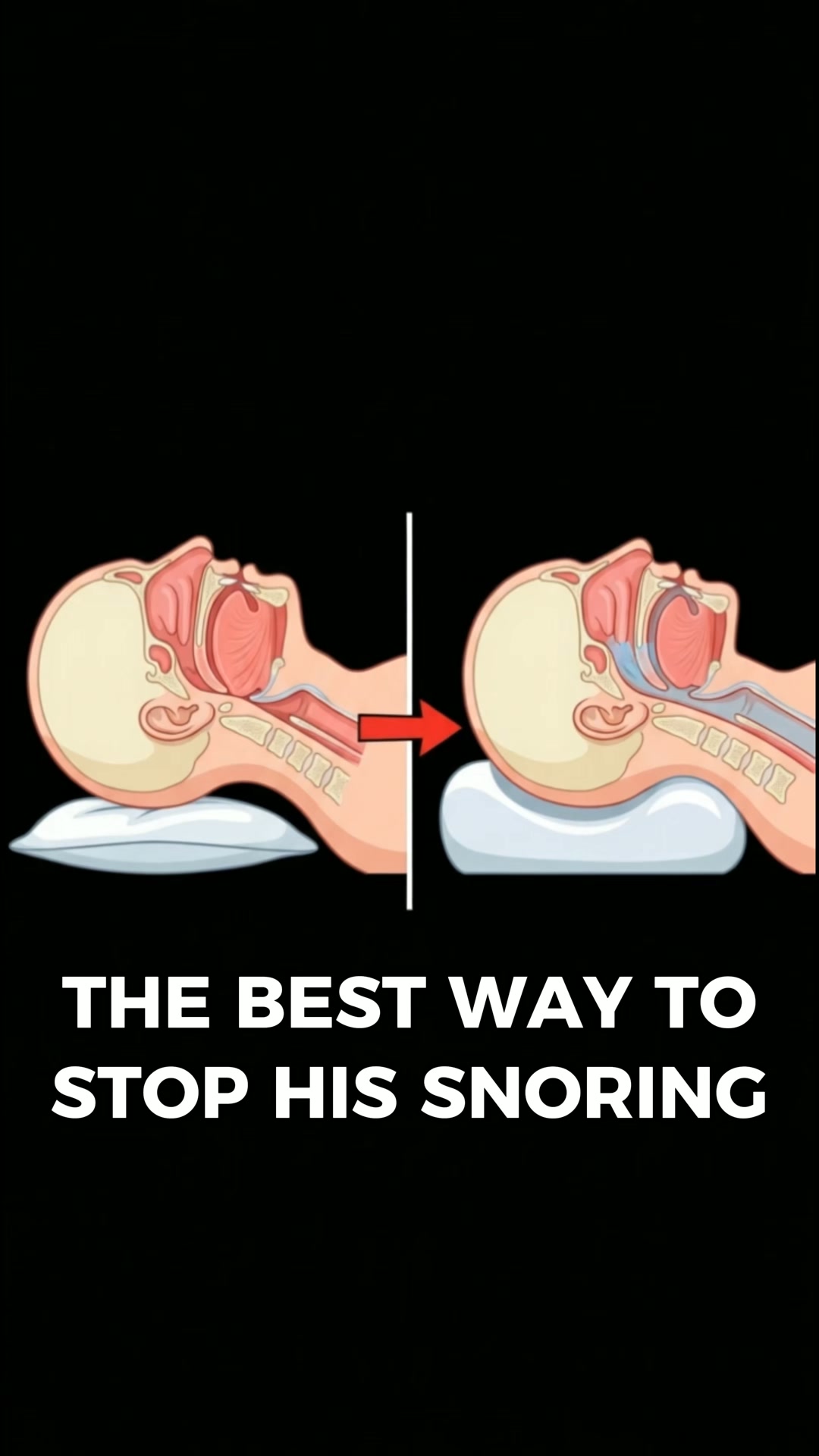 Your Snoring Isn't a Habit. It's a Neck Positioning Problem. And a Pillow Just Solved It.