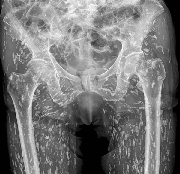 The Reason Your DEXA Numbers Won't Move