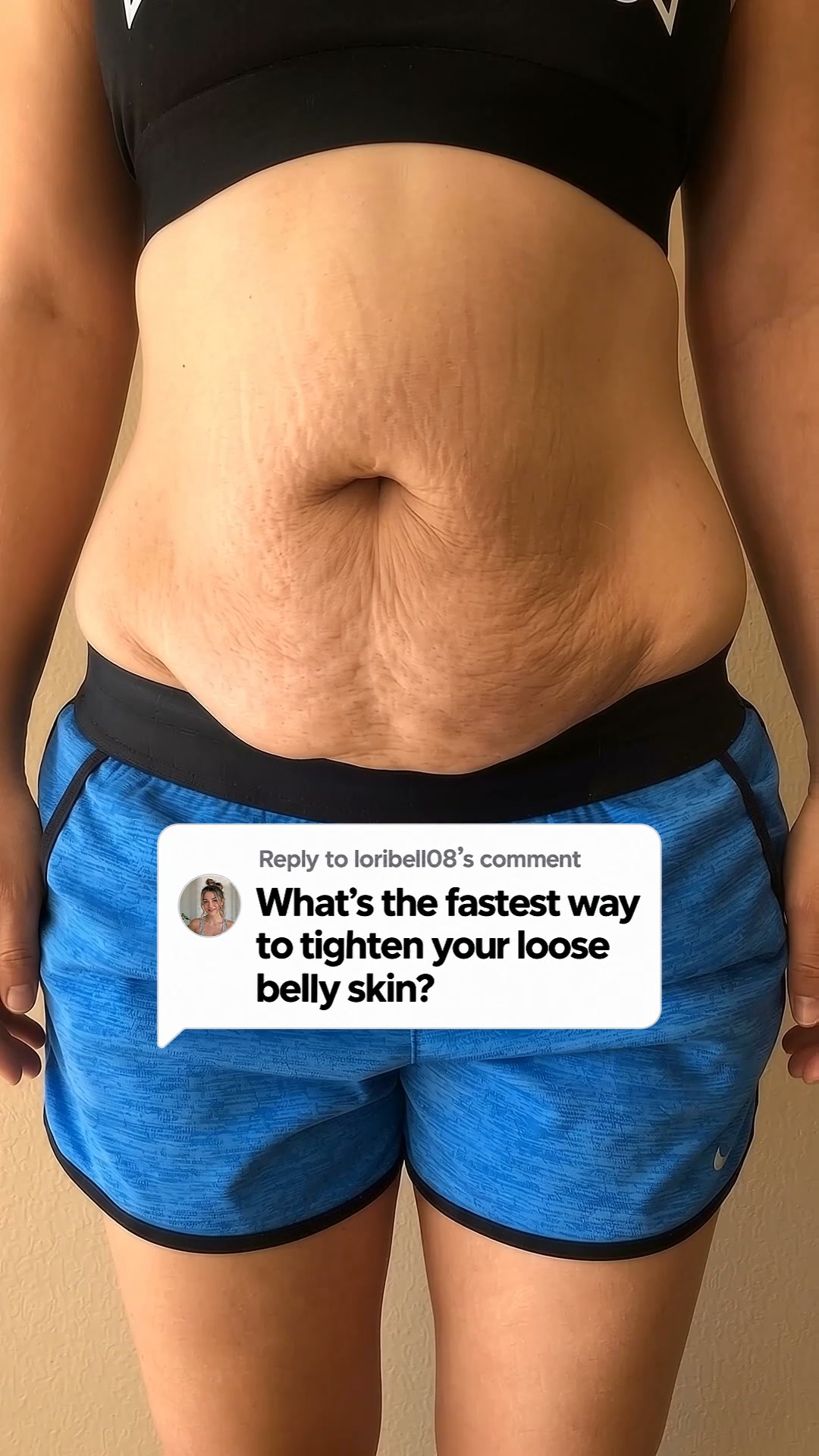 Read this before if you have stretch marks.