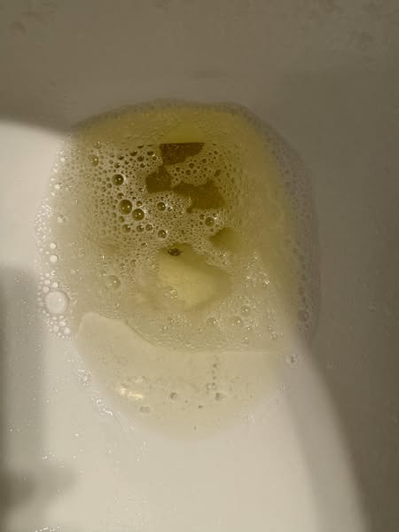 Det farligaste tecknet på njurskador är inte vad du tror