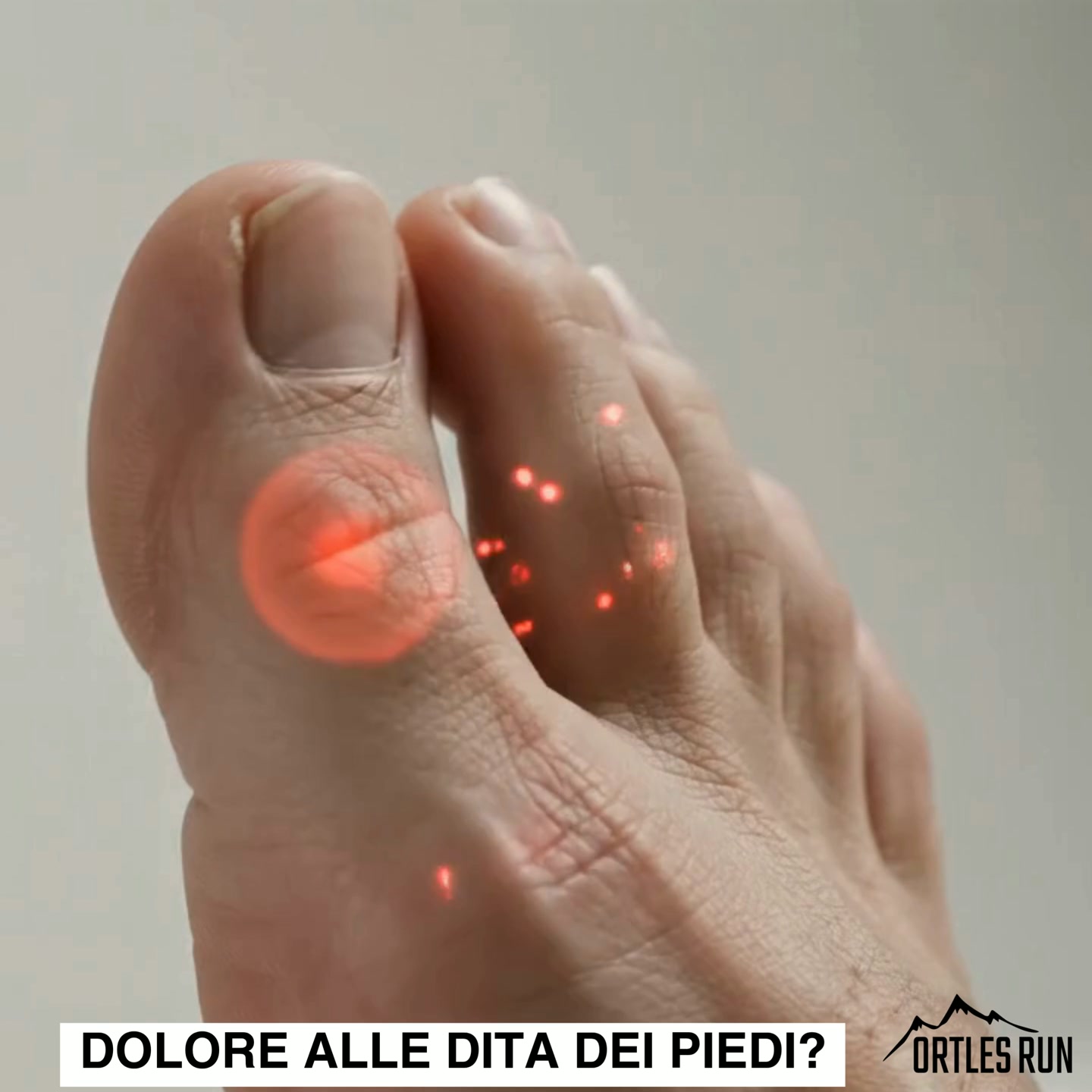 Neuroma o Alluce Valgo? Il sollievo è a 5 dita