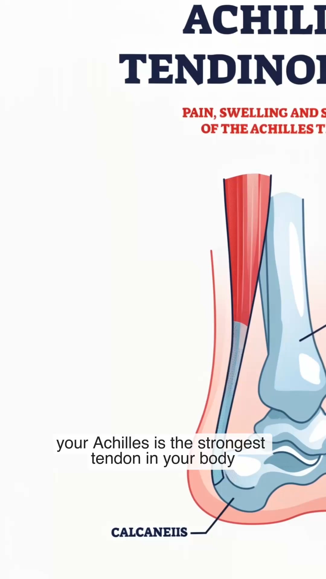 Give Your Achilles Extra Support