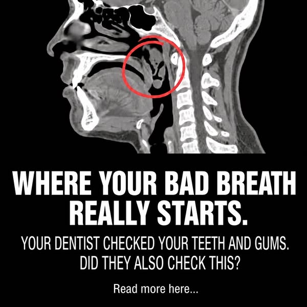 Why brushing and mouthwash don't fix bad breath