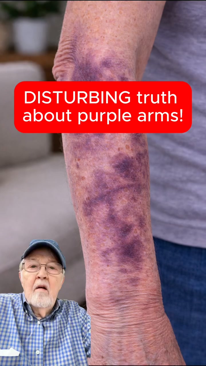 Bruises Gone In Days!