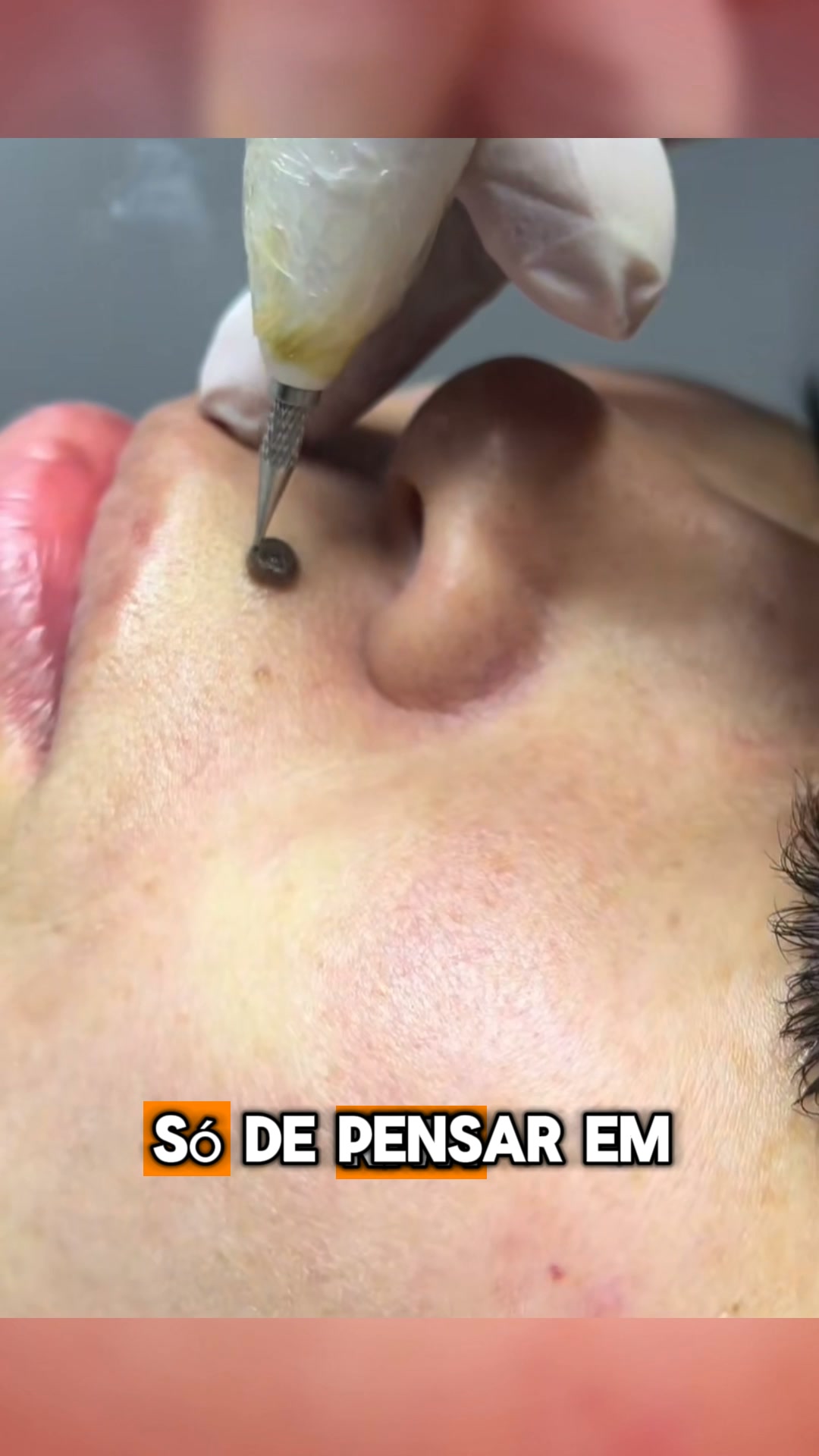 SÓ HOJE: Recupere a sua pele sem dor