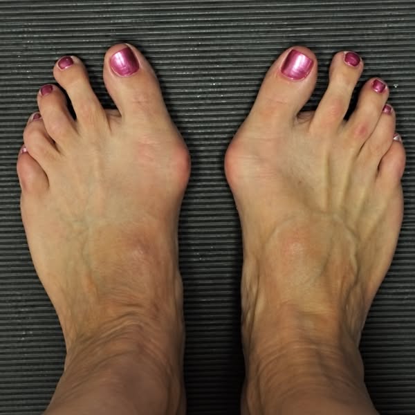 Read This If Your Shoes Hurt Your Bunions