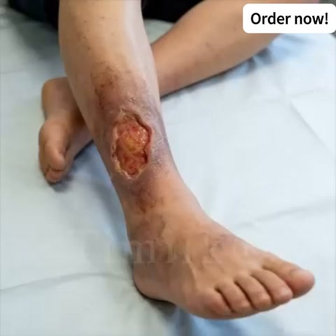 La solución más sencilla y cómoda para el cuidado diario de los pies de personas con diabetes