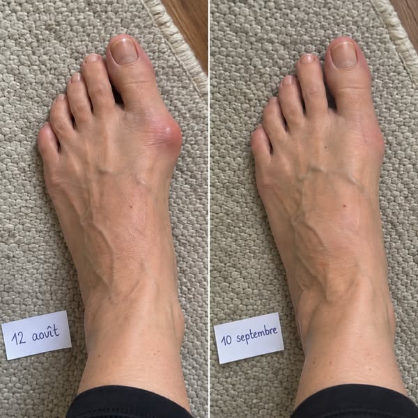 Si vous avez un hallux valgus et que vous pensez que l’opération est l’unique solution, lisez ceci.
