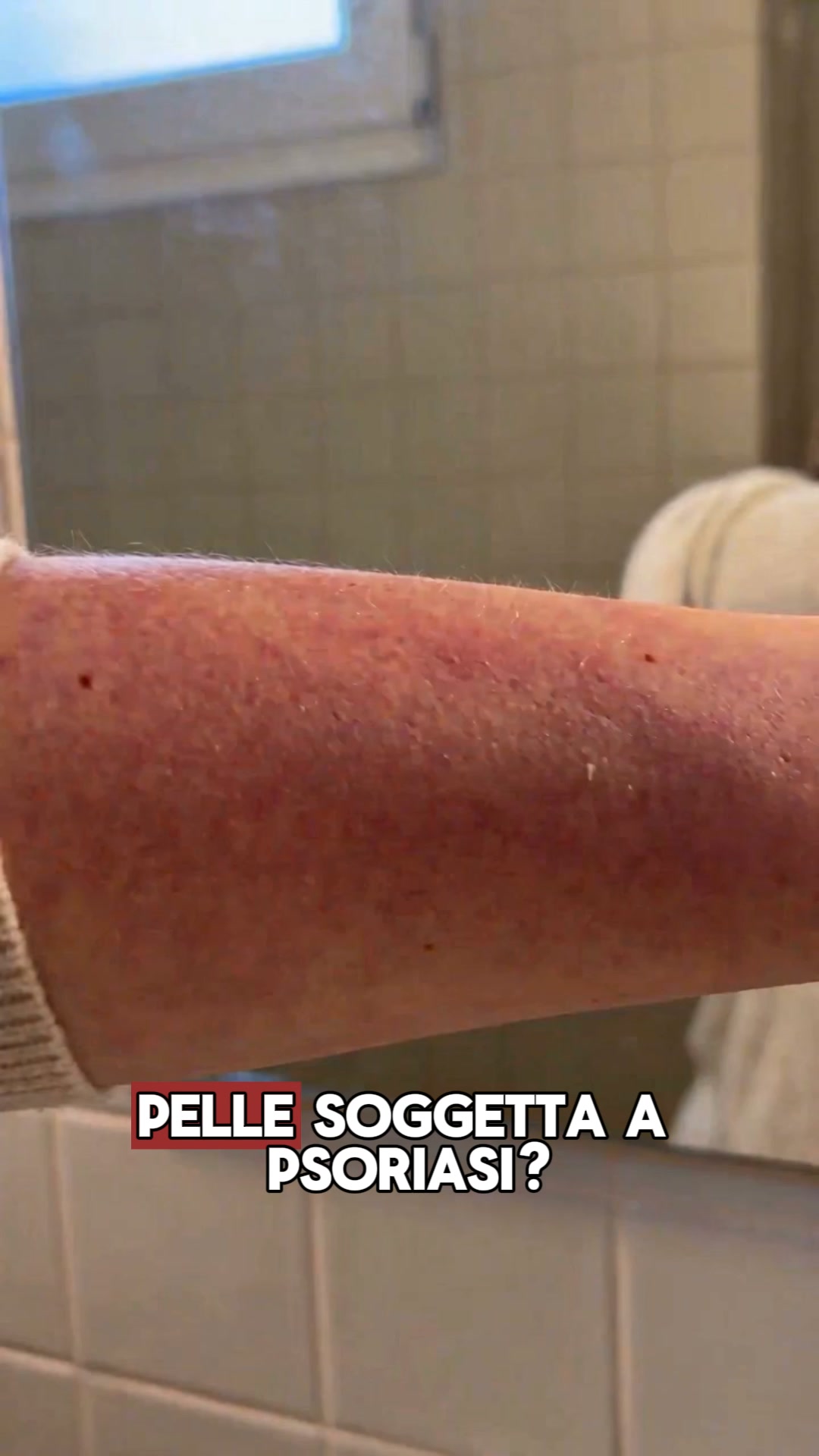 Supporto naturale per la tua psoriasi
