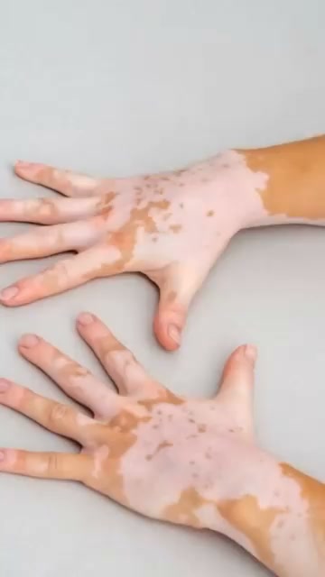 To anyone hiding their skin this summer: your pigment cells aren't gone, they’re just resting.