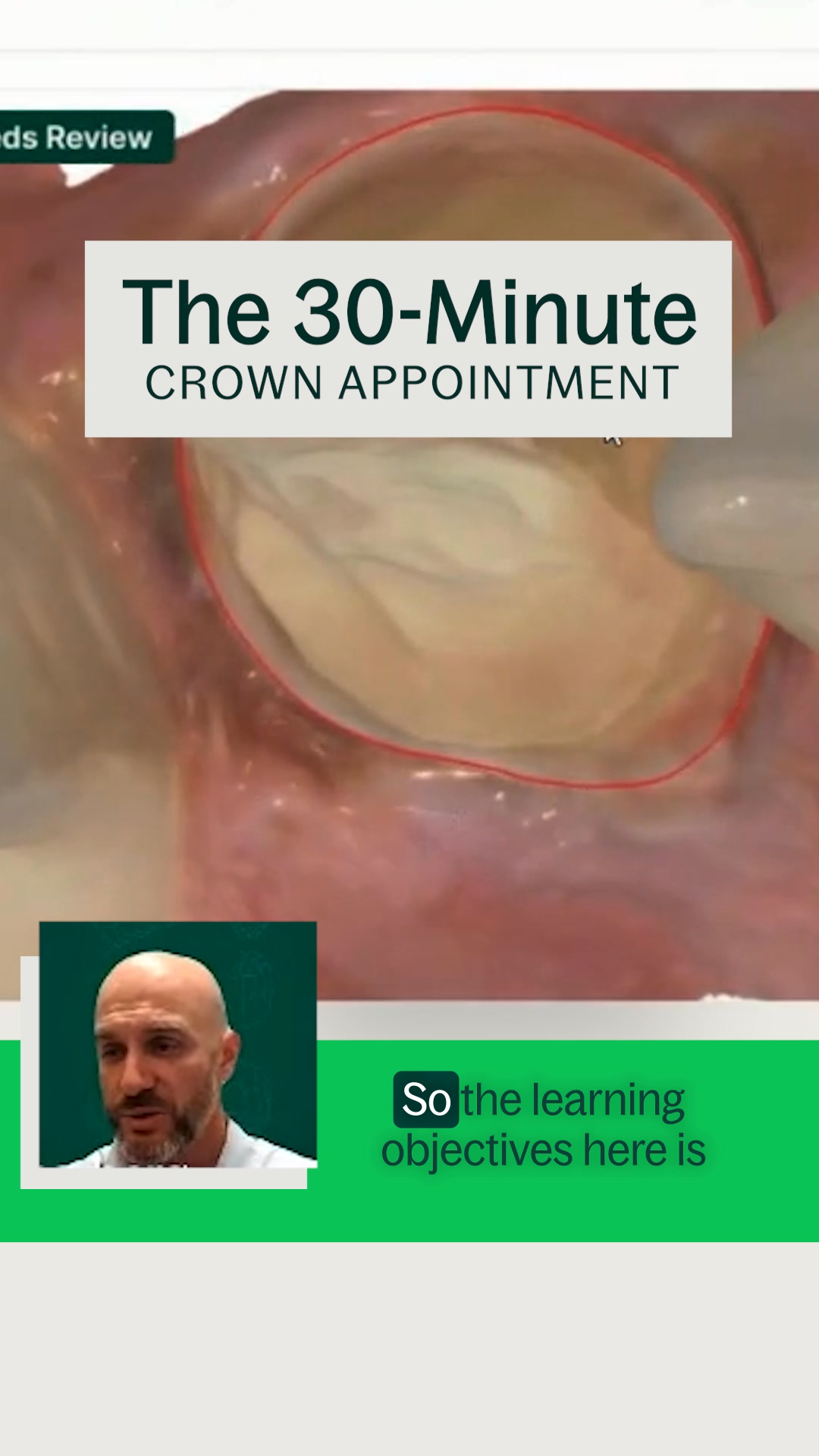Webinar: 30-Minute Crown Prep