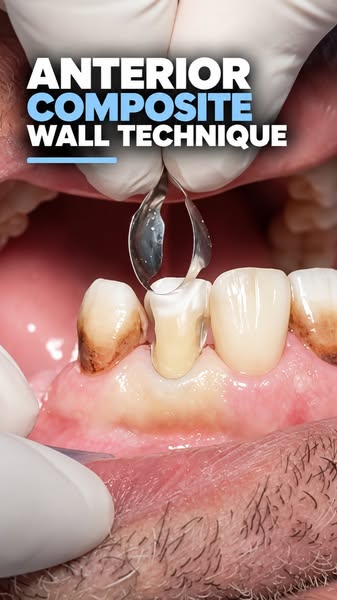 Anterior Sectional Matrices, Done Right