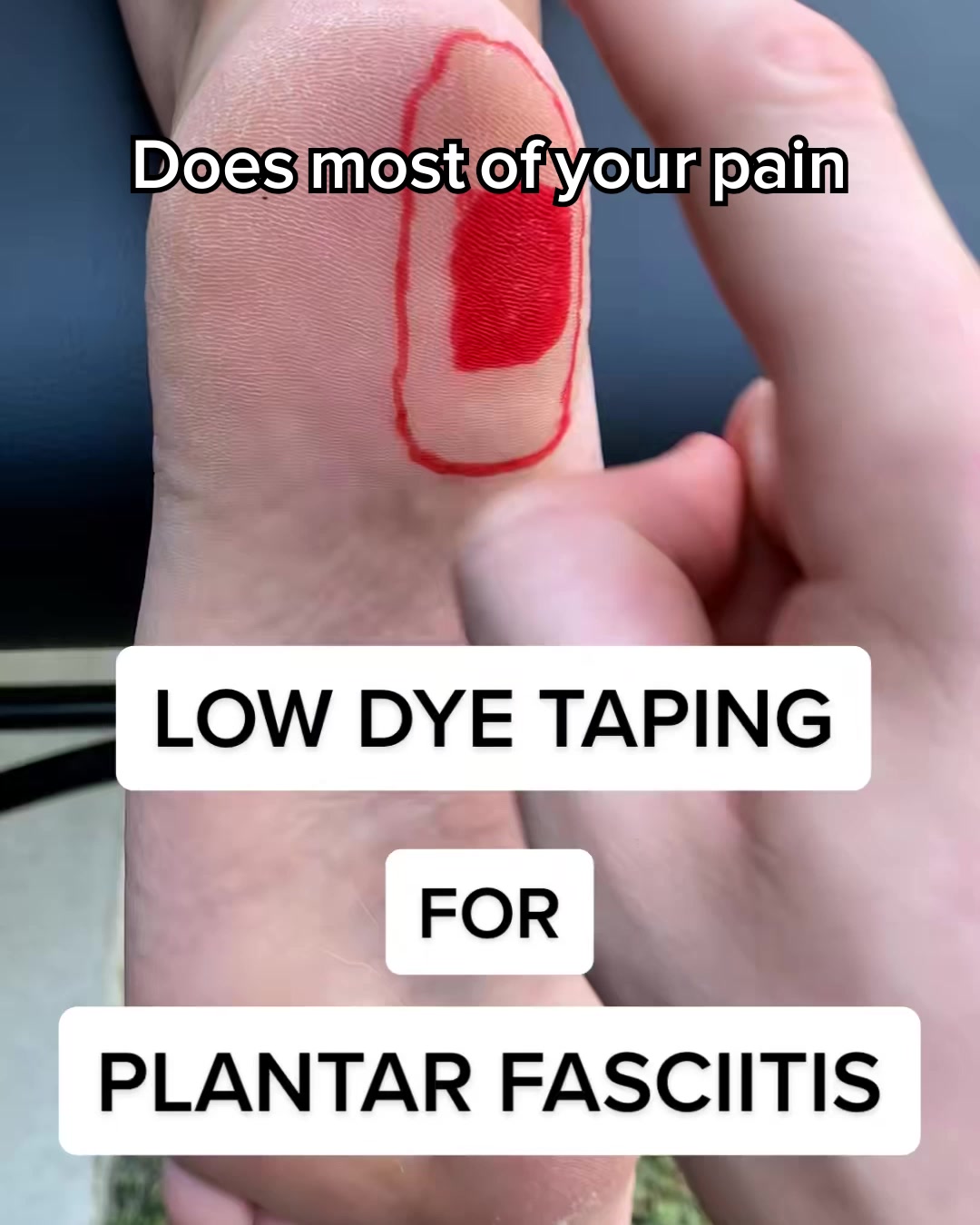 Unveiling 2025's Breakthrough Cure for Plantar Fasciitis