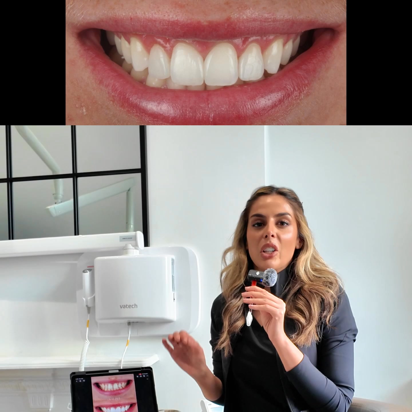 3,400 Patients. Zero Turkey Teeth. Here Is How We Do Composite Bonding Differently.