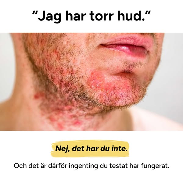 Lindra Klåda, Minska Fjällning, Må Bättre
