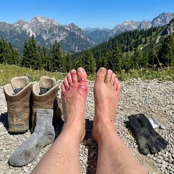 The burning in your feet getting quieter is not a good sign. The research describes it as the opposite.