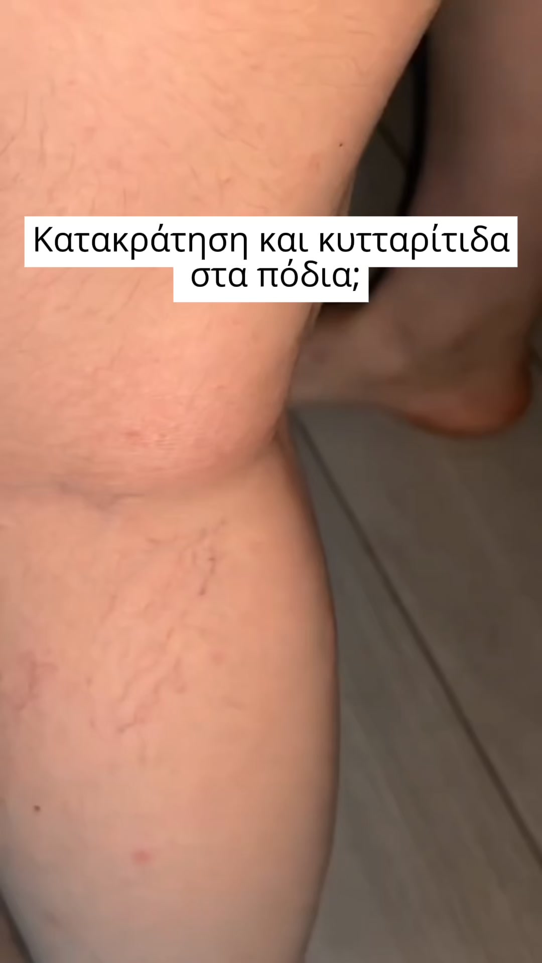 Πιο Λεία Όψη, Λιγότερο Έντονη Κυτταρίτιδα