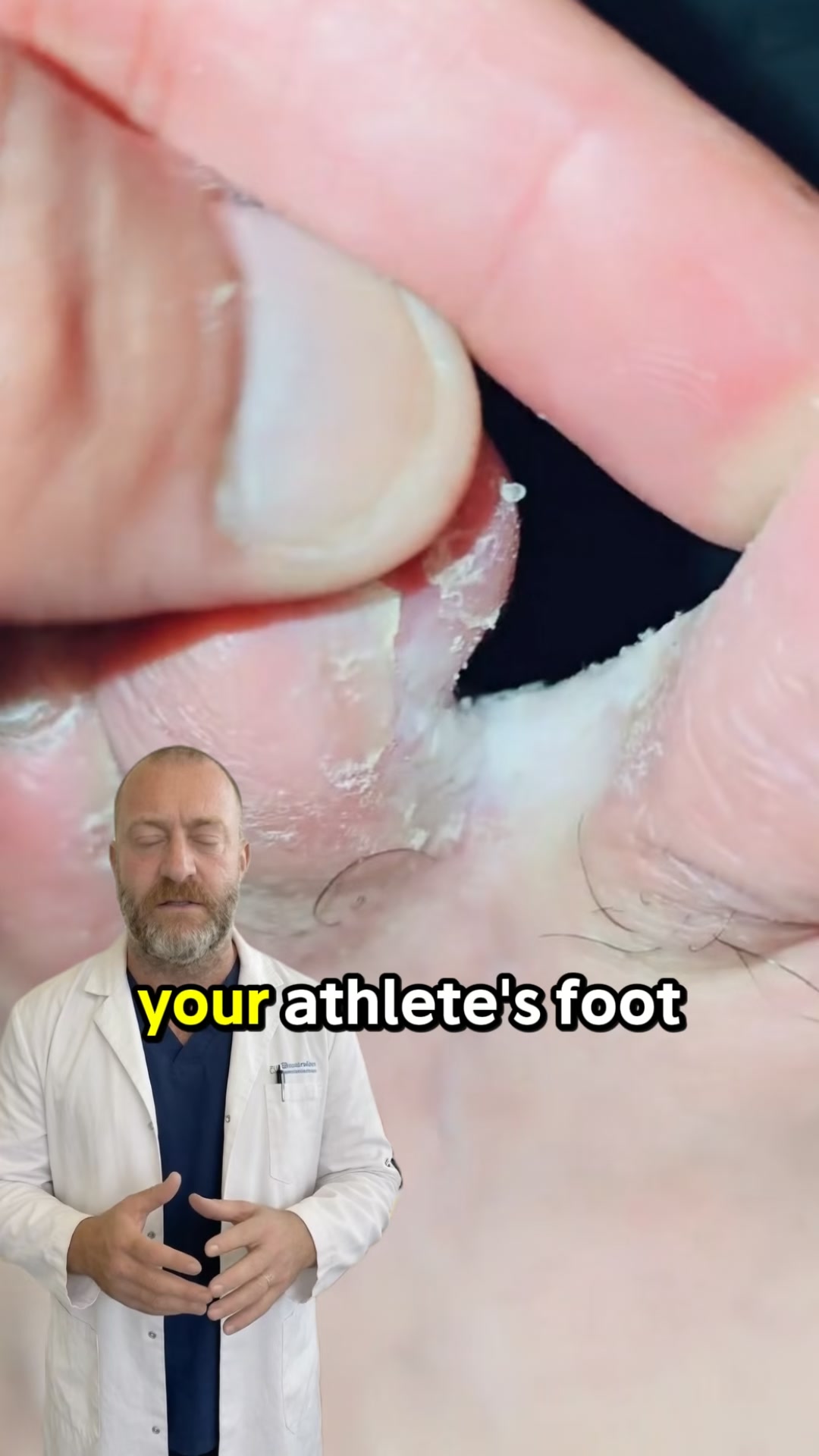 Stop The Athlete's Foot Cycle.