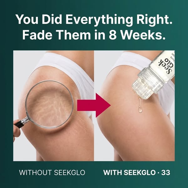 Stretch Marks? Try This At Home