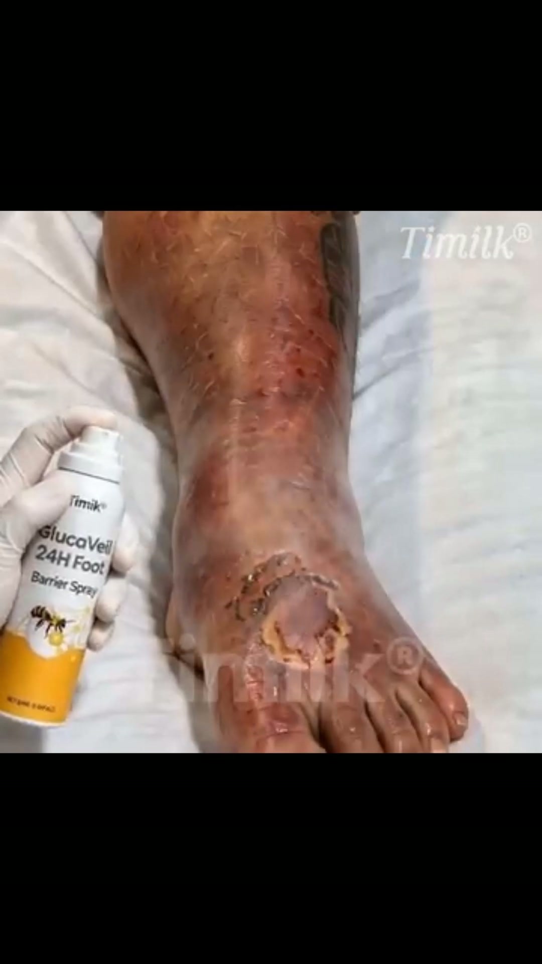 Shield Fragile Feet in Just 60 Seconds!